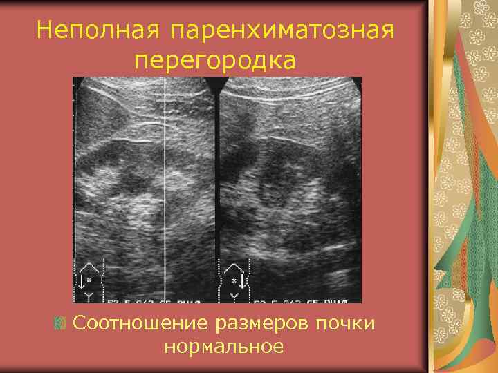 Неполная паренхиматозная перегородка Соотношение размеров почки нормальное 