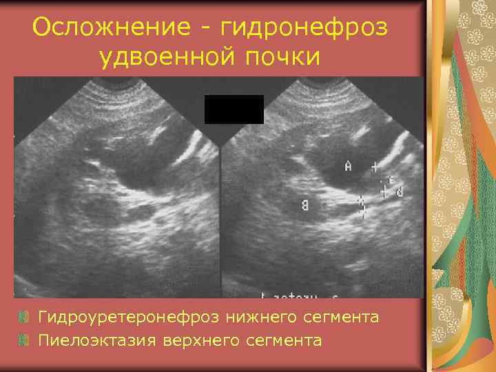 Осложнение - гидронефроз удвоенной почки Гидроуретеронефроз нижнего сегмента Пиелоэктазия верхнего сегмента 