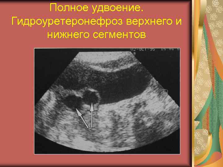 Полное удвоение. Гидроуретеронефроз верхнего и нижнего сегментов 