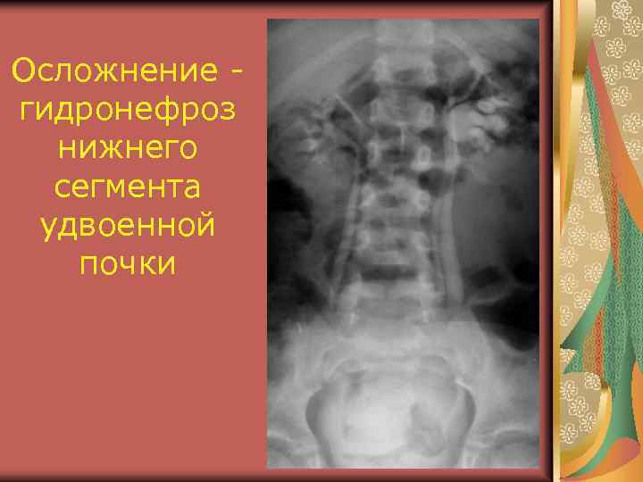 Осложнение гидронефроз нижнего сегмента удвоенной почки 