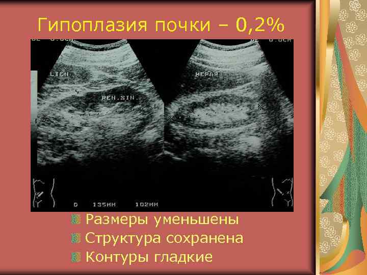 Гипоплазия почки – 0, 2% Размеры уменьшены Структура сохранена Контуры гладкие 