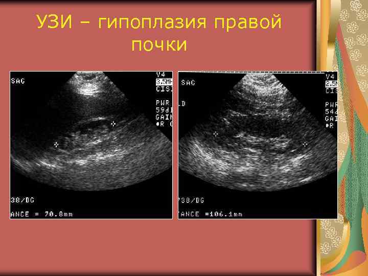 УЗИ – гипоплазия правой почки 