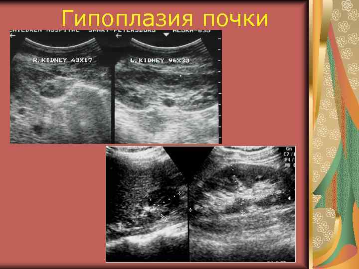 Гипоплазия почки 