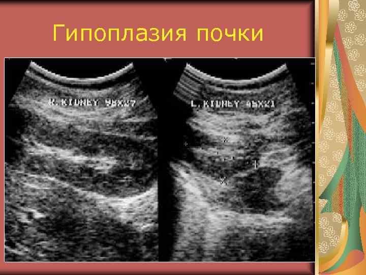 Гипоплазия почки 