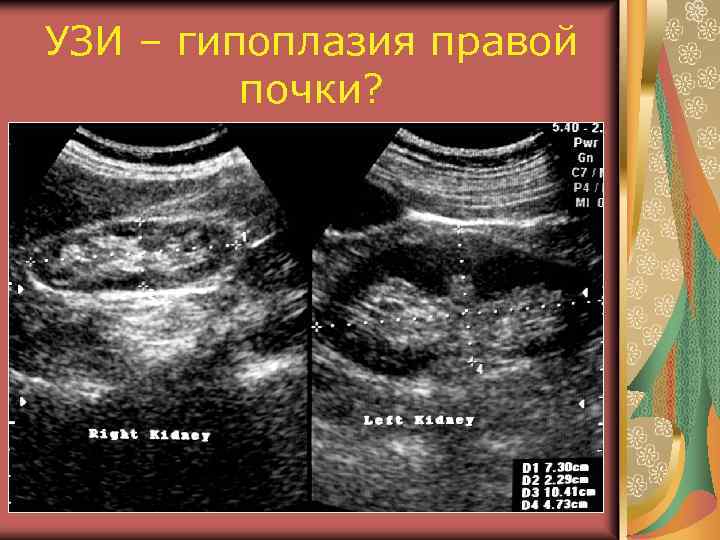 УЗИ – гипоплазия правой почки? 