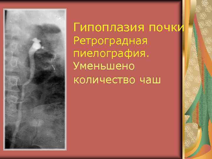 Гипоплазия почки Ретроградная пиелография. Уменьшено количество чаш 