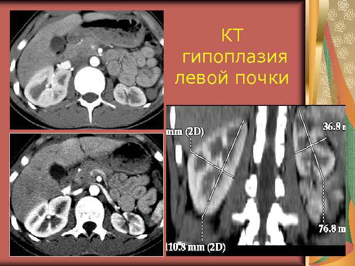 КТ гипоплазия левой почки 