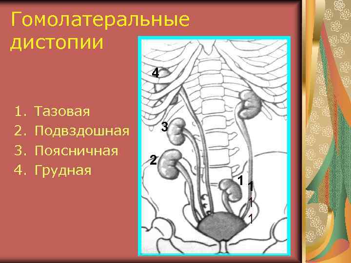 Аномалия развития почек презентация