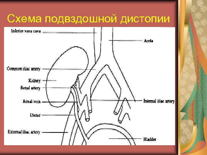 Схема подвздошной дистопии 