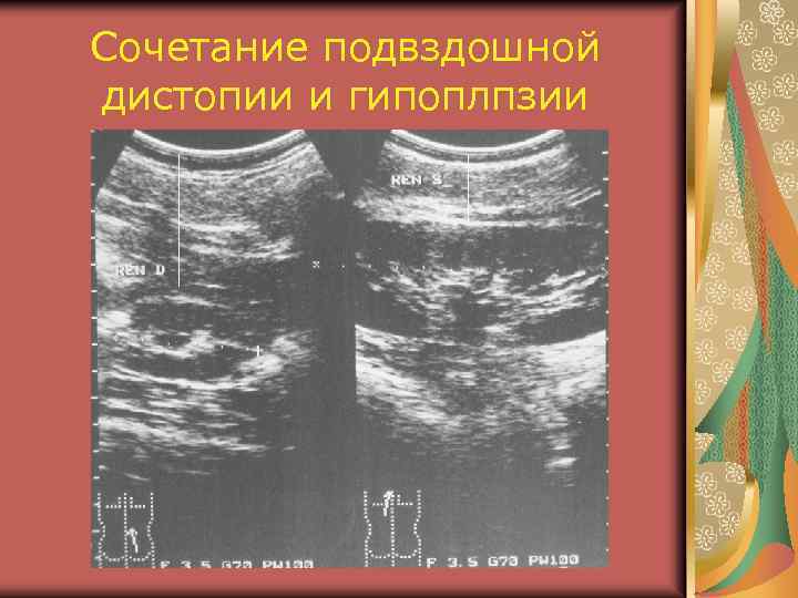 Сочетание подвздошной дистопии и гипоплпзии 