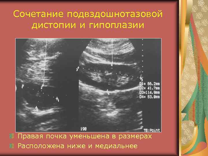 Сочетание подвздошнотазовой дистопии и гипоплазии Правая почка уменьшена в размерах Расположена ниже и медиальнее