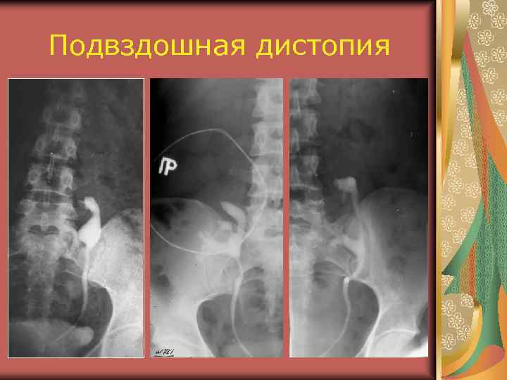 Подвздошная дистопия 