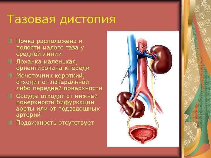 Тазовая дистопия Почка расположена в полости малого таза у средней линии Лоханка маленькая, ориентирована