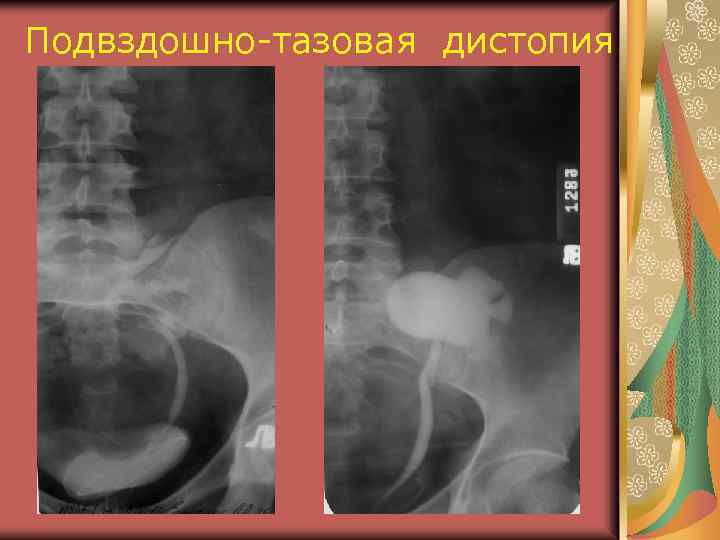 Подвздошно-тазовая дистопия 