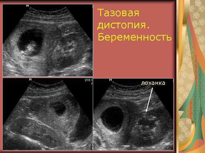 Тазовая дистопия. Беременность лоханка 