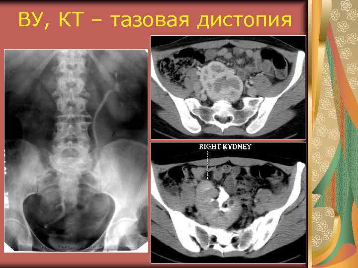 ВУ, КТ – тазовая дистопия 