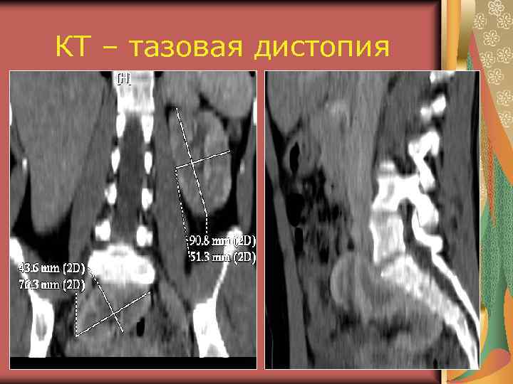 КТ – тазовая дистопия 