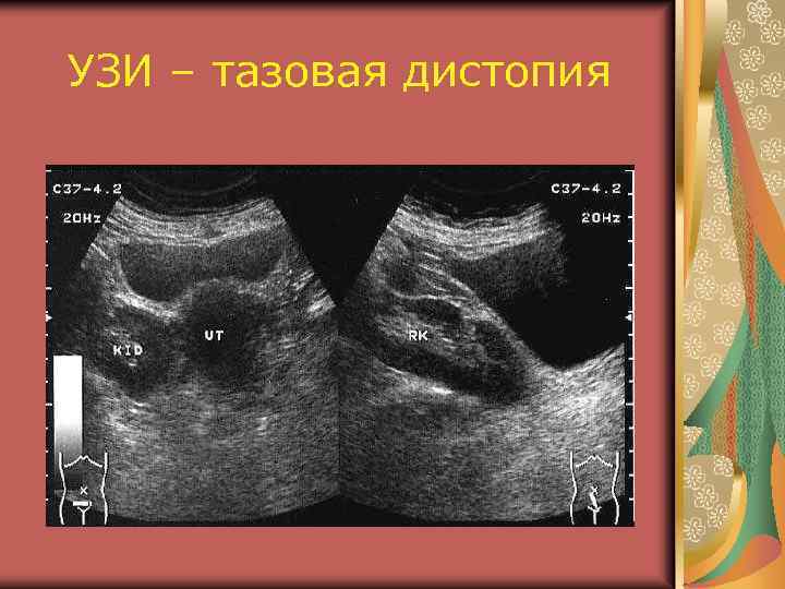 УЗИ – тазовая дистопия 