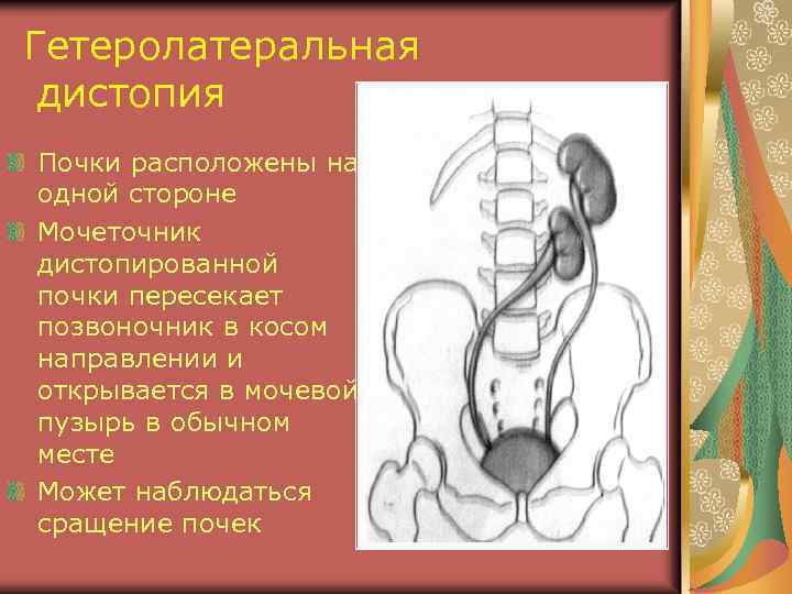 Аномалии почек презентация