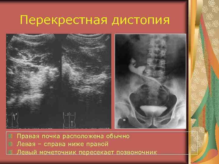 Перекрестная дистопия Правая почка расположена обычно Левая – справа ниже правой Левый мочеточник пересекает