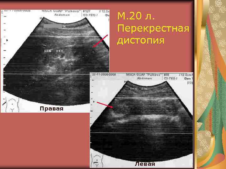 М. 20 л. Перекрестная дистопия Правая Левая 