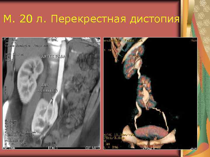 Аномалии почек презентация