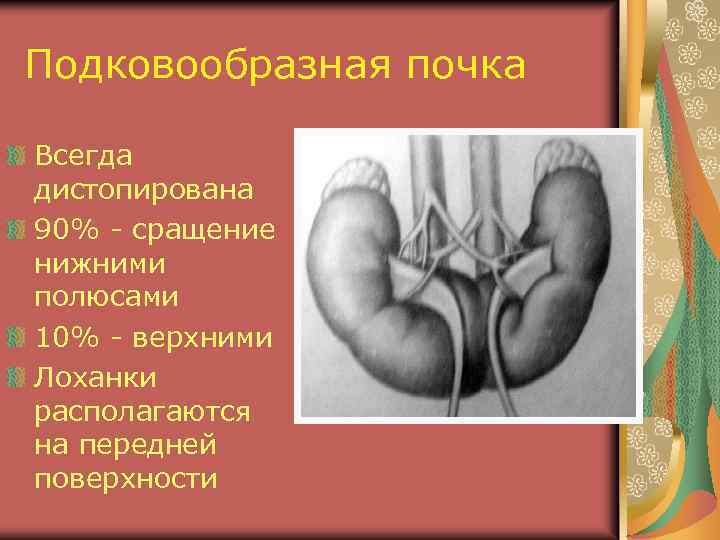 Подковообразная почка Всегда дистопирована 90% - сращение нижними полюсами 10% - верхними Лоханки располагаются