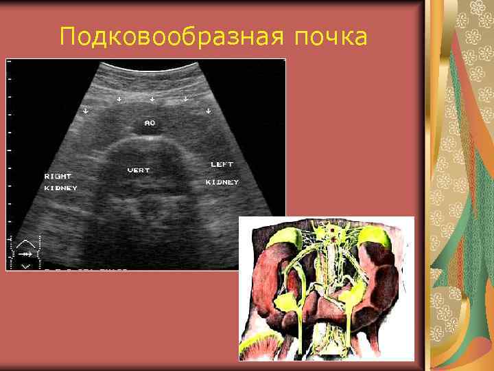 Подковообразная почка 