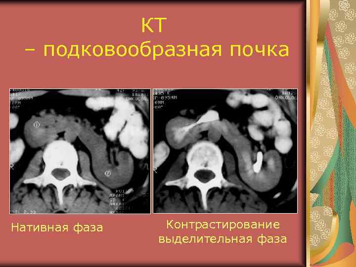 КТ – подковообразная почка Нативная фаза Контрастирование выделительная фаза 