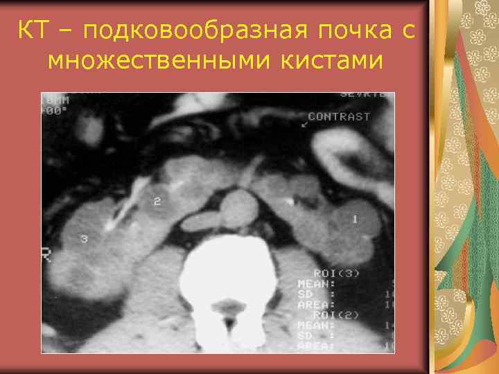 КТ – подковообразная почка с множественными кистами 