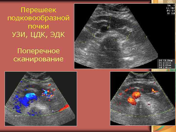 Перешеек подковообразной почки УЗИ, ЦДК, ЭДК Поперечное сканирование 