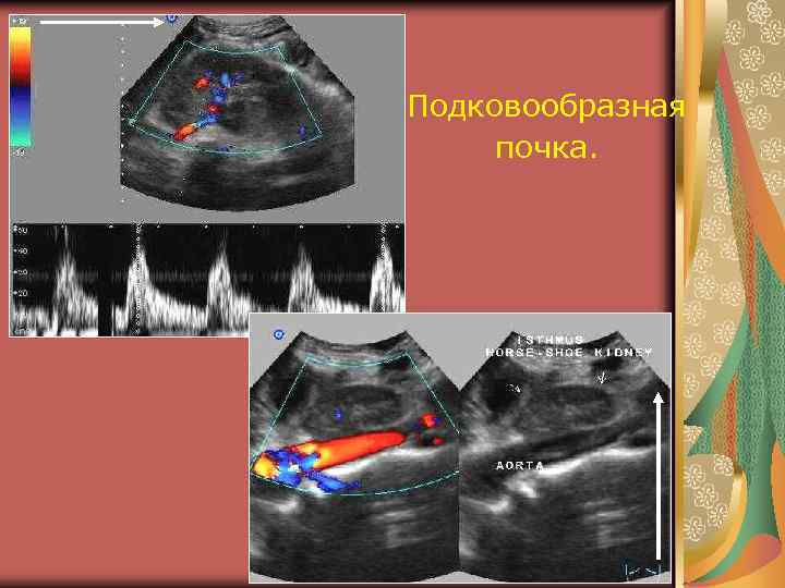 Подковообразная почка. 