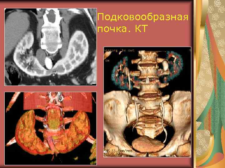 Подковообразная почка. КТ 