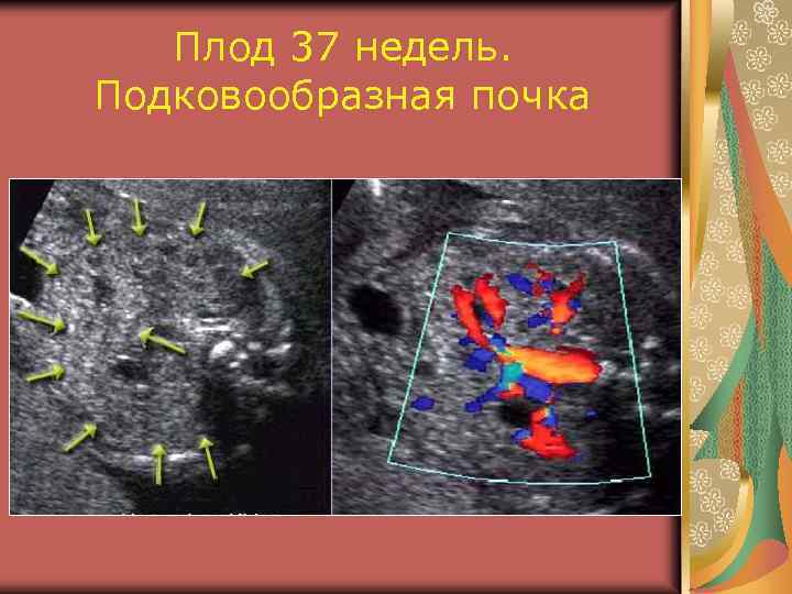 Плод 37 недель. Подковообразная почка 