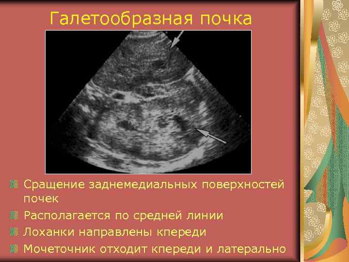 Галетообразная почка Сращение заднемедиальных поверхностей почек Располагается по средней линии Лоханки направлены кпереди Мочеточник