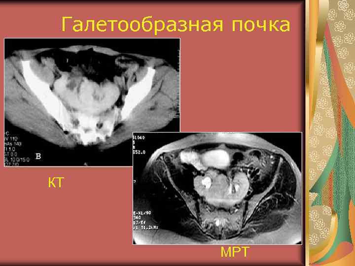 Галетообразная почка КТ МРТ 