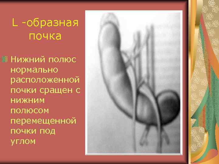 L -образная почка Нижний полюс нормально расположенной почки сращен с нижним полюсом перемещенной почки