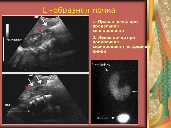 L -образная почка 1. Правая почка при продольном сканировании 2. Левая почка при поперечном