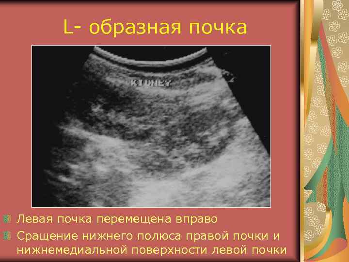 L- образная почка Левая почка перемещена вправо Сращение нижнего полюса правой почки и нижнемедиальной