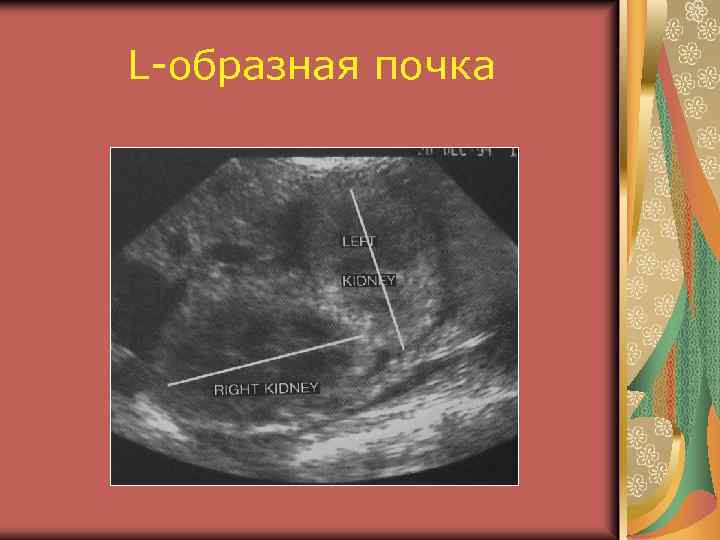 L-образная почка 