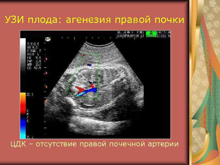 УЗИ плода: агенезия правой почки ЦДК – отсутствие правой почечной артерии 