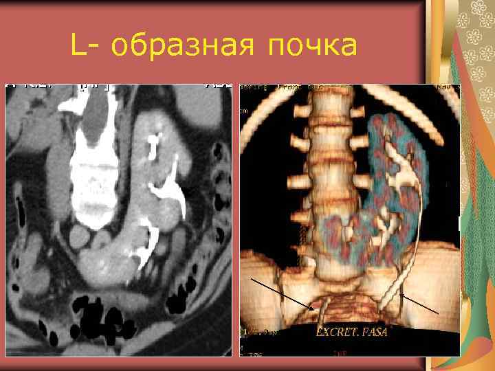 Аномалии развития почки картинки