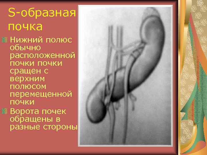 S-образная почка Нижний полюс обычно расположенной почки сращен с верхним полюсом перемещенной почки Ворота