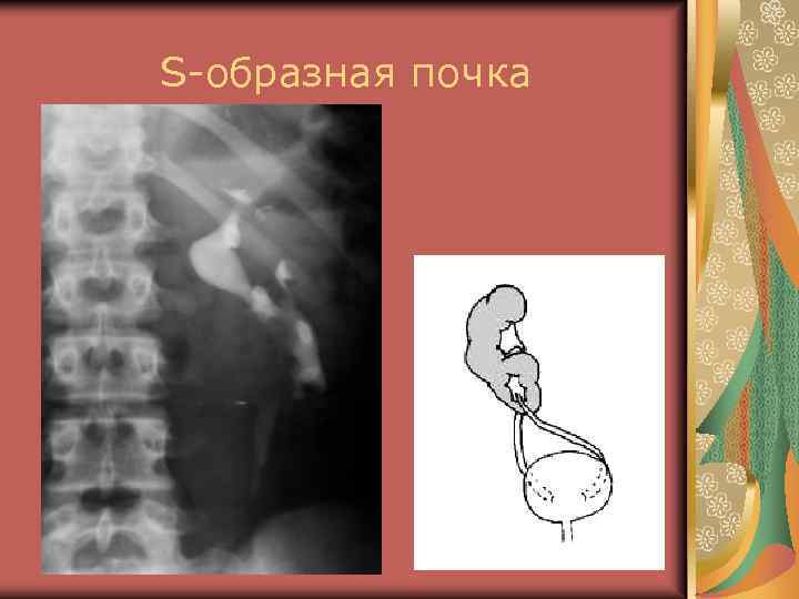 S-образная почка 