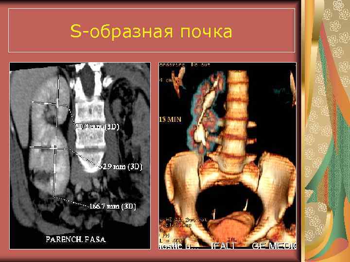 S-образная почка 