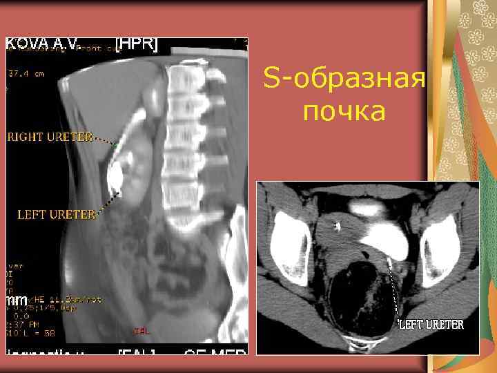 Аномалии развития почки картинки