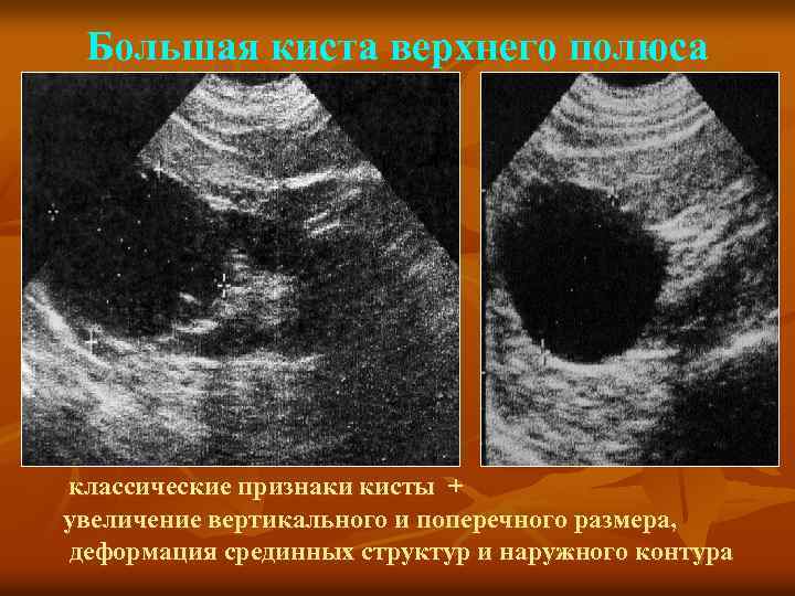 Большая киста верхнего полюса классические признаки кисты + увеличение вертикального и поперечного размера, деформация