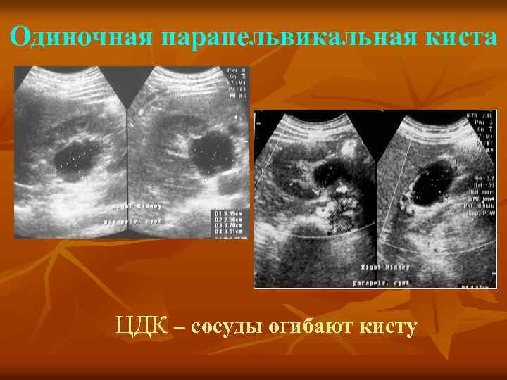 Одиночная парапельвикальная киста ЦДК – сосуды огибают кисту 