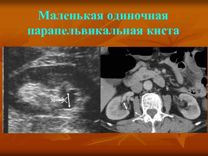 Маленькая одиночная парапельвикальная киста 
