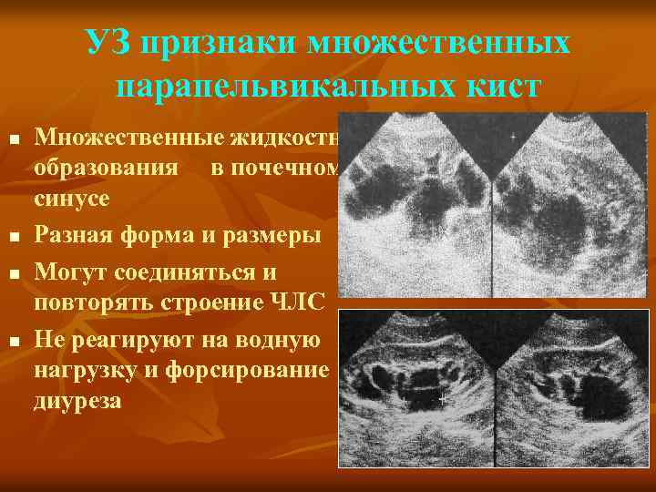 УЗ признаки множественных парапельвикальных кист n n Множественные жидкостные образования в почечном синусе Разная
